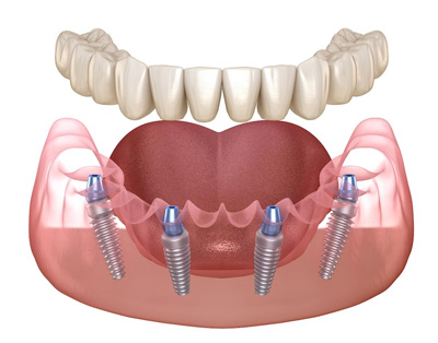 All-on-4 Dental Implants Trumbullt