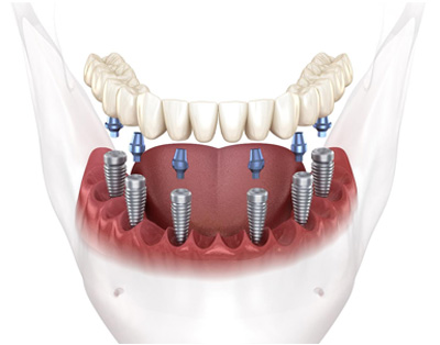 All-on-6 Dental Implants in Trumbull