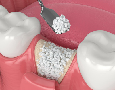 Bone Graft Dentist in Trumbull